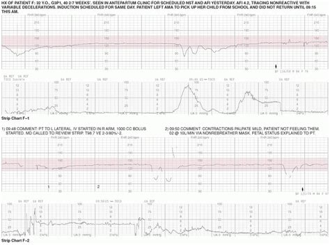 fetal monitoring strips practice|Exercises in Electronic Fetal Monitoring .